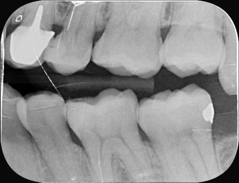 齒雕 #36 銀粉填補裂痕功能恢復 術後Xray｜桃園鍾國耀醫師