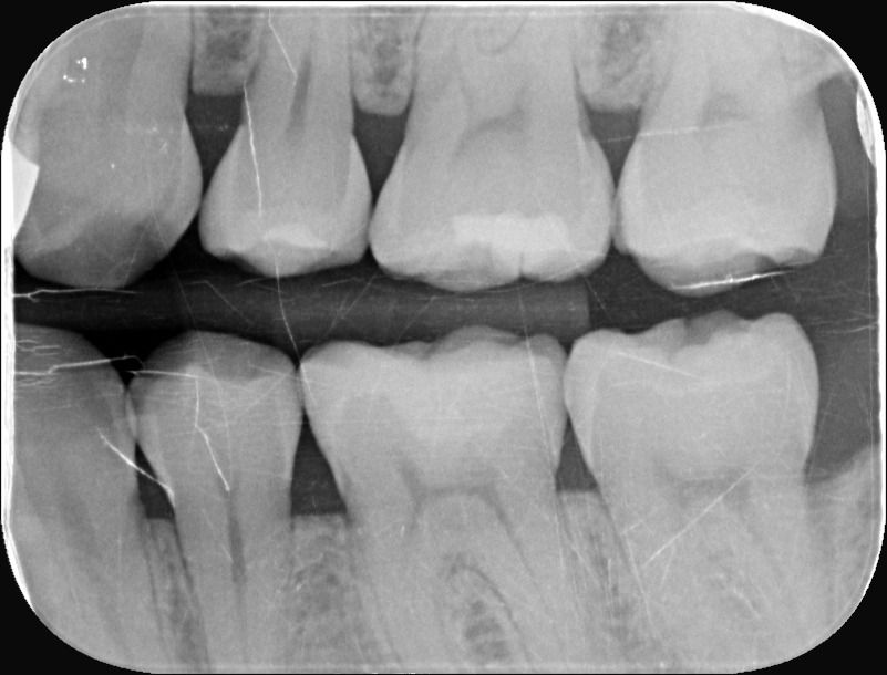齒雕 #36 銀粉裂痕 結構補強 術後Xray｜桃園鍾國耀醫師