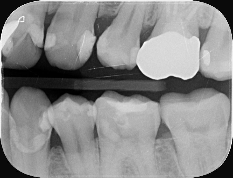 齒雕 #37 舊補綴失效 結構修復 術後Xray｜桃園鍾國耀醫師