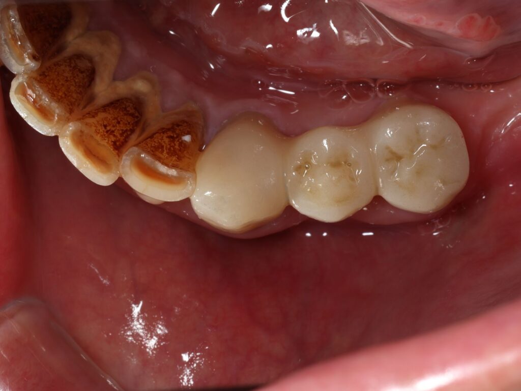 全瓷冠 #43 #45 牙根斷裂感染 牙橋重建 術後occlusal view|桃園鍾國耀醫師