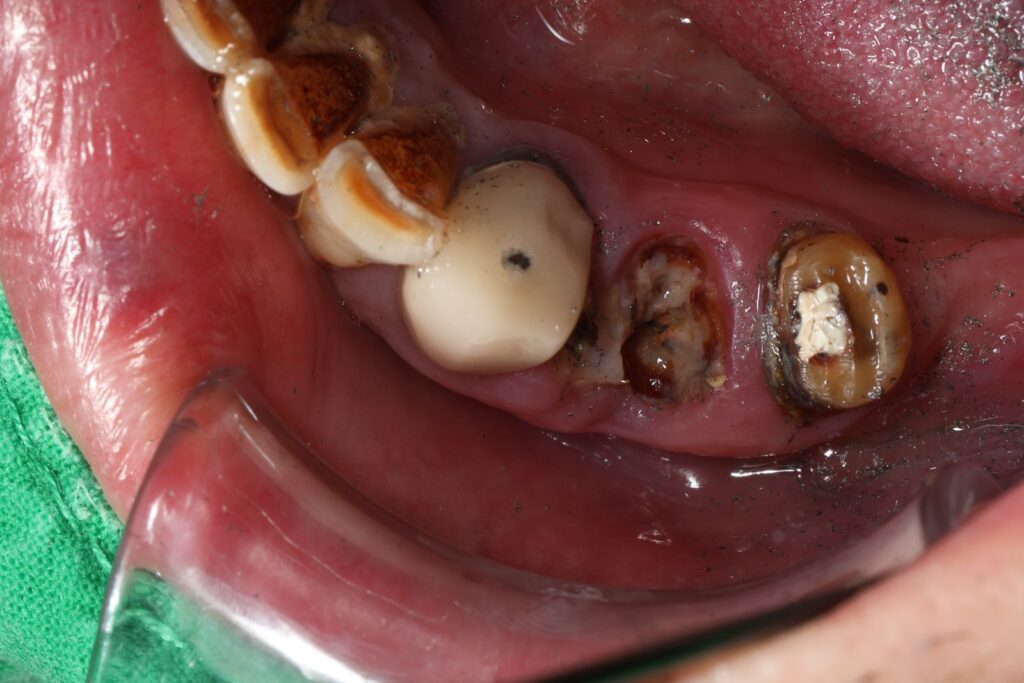 全瓷冠 #43 #45 牙根斷裂感染 牙橋重建 術前occlusal view|桃園鍾國耀醫師