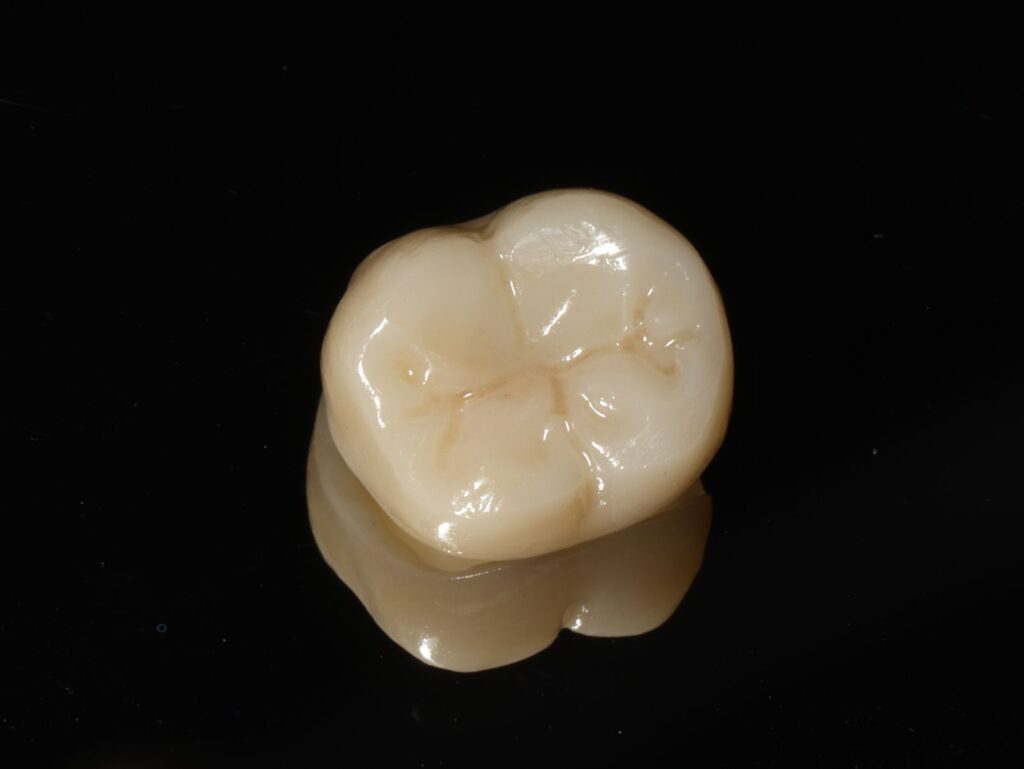 全瓷冠 #47 根管治療後裂痕 結構保護 allceramic crown｜桃園鍾國耀醫師