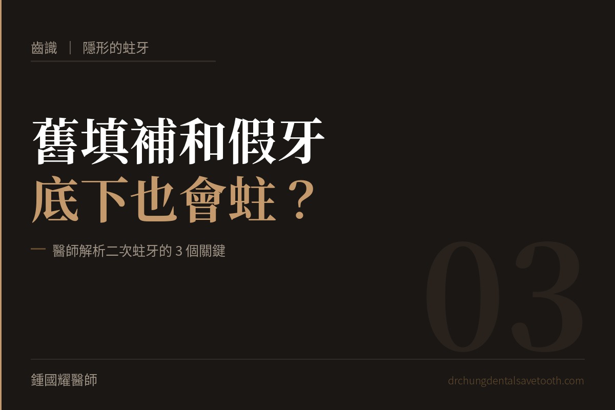 隱形的蛀牙 舊填補和假牙底下也會蛀？醫師解析二次蛀牙的3個關鍵｜桃園鍾國耀醫師