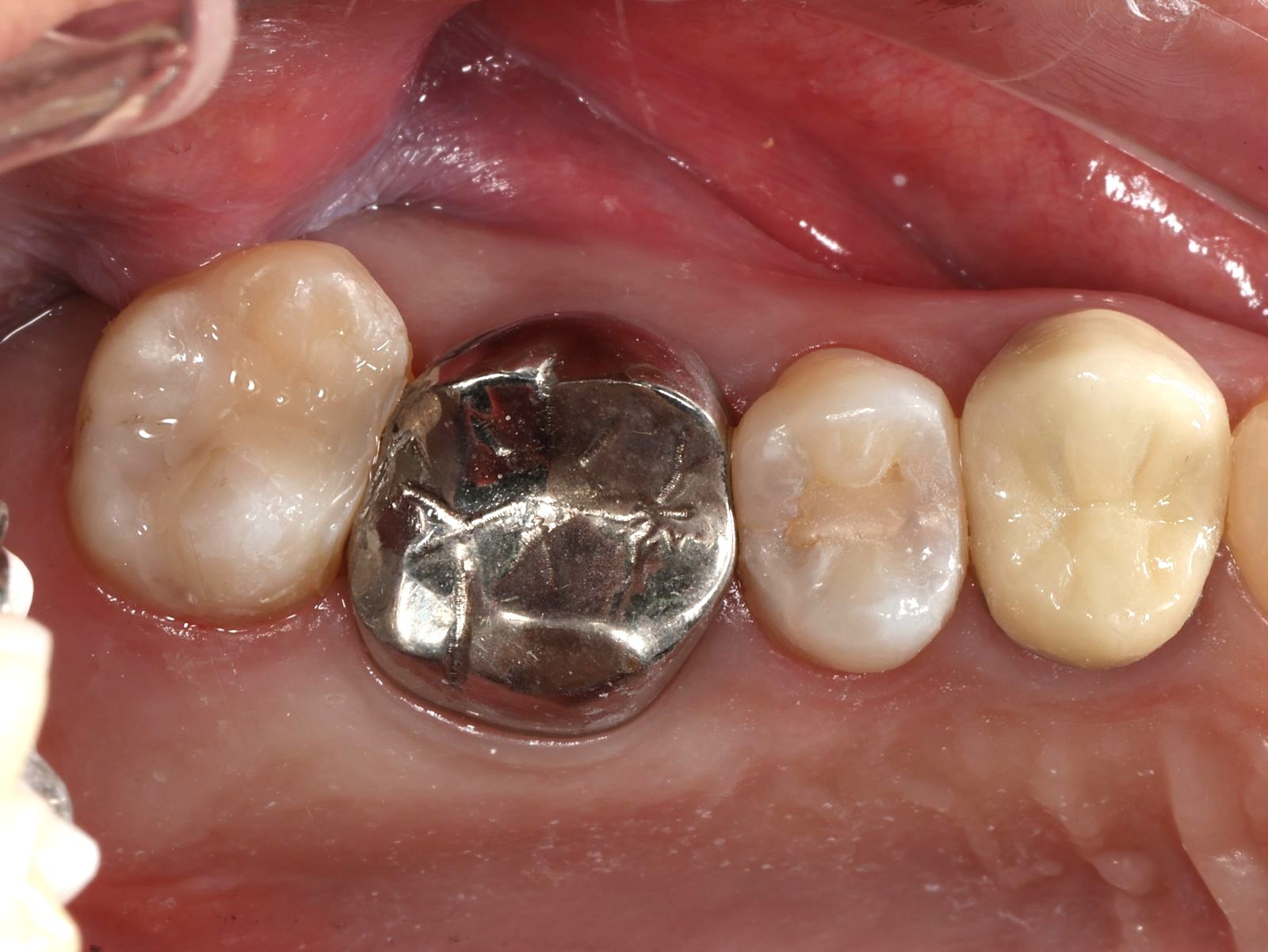 齒雕案例 治療後 #27
